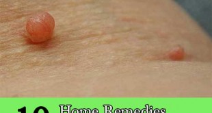 10 Home Remedies To Remove Skin Tags