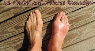 Getting Over Gout: 11 Herbal and Natural Remedies