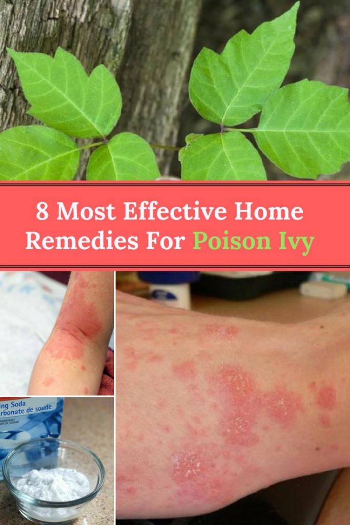 home remedies for poison ivy