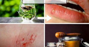 14 Bizarre and Effective Home Remedies