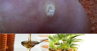 8 Natural Home Remedies To Get Rid of Warts