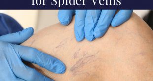 Herbal Remedies for Spider Veins