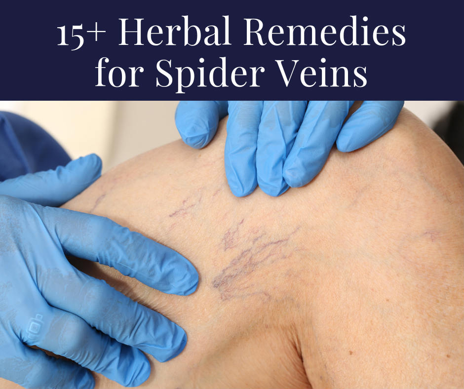 15 Herbal Remedies For Spider Veins Home And Gardening Ideas
